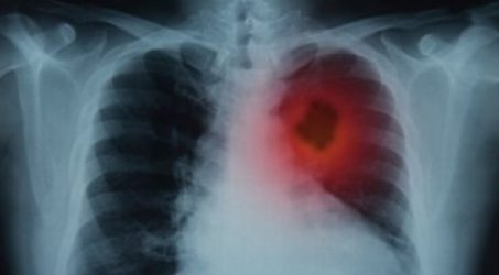 YLKI usulkan pemerintah buat peta kanke