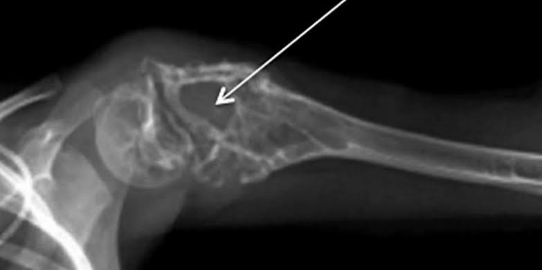 7 Cara Pemeriksaan dan Diagnosis Kanker Sarkoma