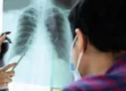 Kejar Target Eliminasi 2030, Dinkes Kota Madiun Intensifkan Temuan Kasus TBC